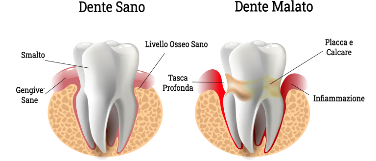 dente-sano-dente-malato