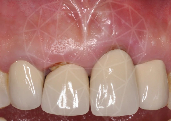 Before-Protesi maschio quarantadue