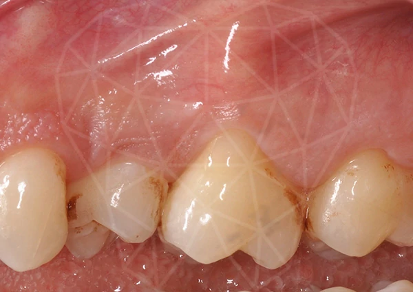 Before-Parodontologia 48 anni