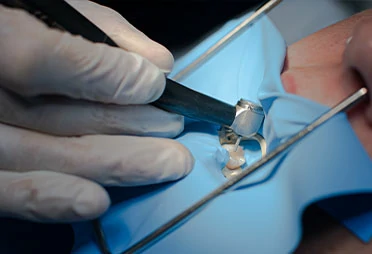 servizi-preview-homepage-endodonzia Endodonzia