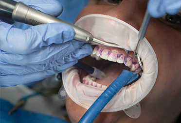 servizi-preview-homepage-parodontologia Parodontologia