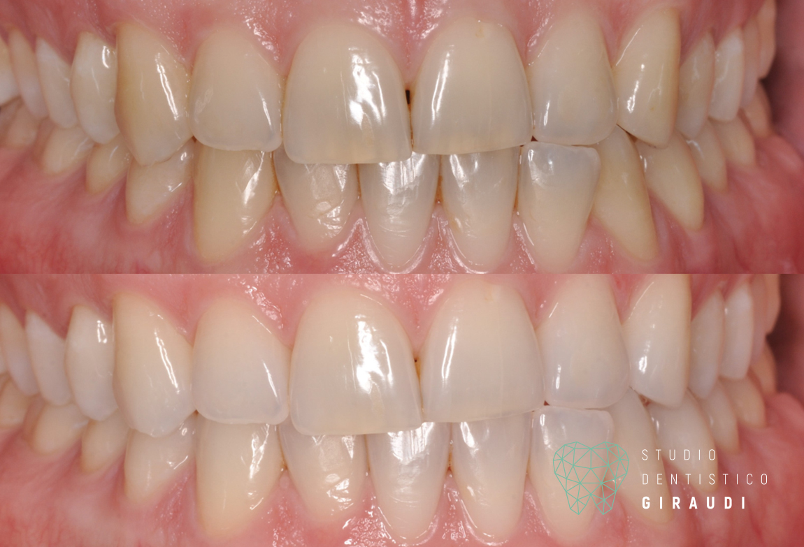 sbiancamento dentale