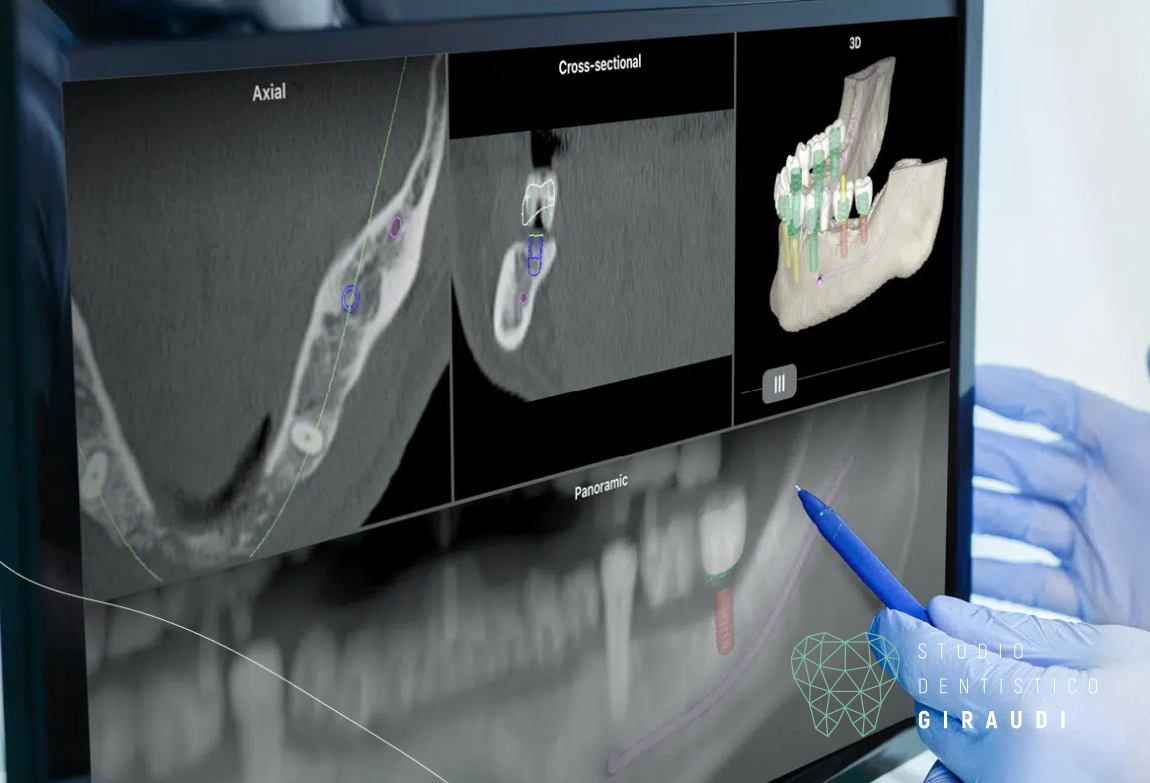 Chirurgia Implantare Computer-Guidata