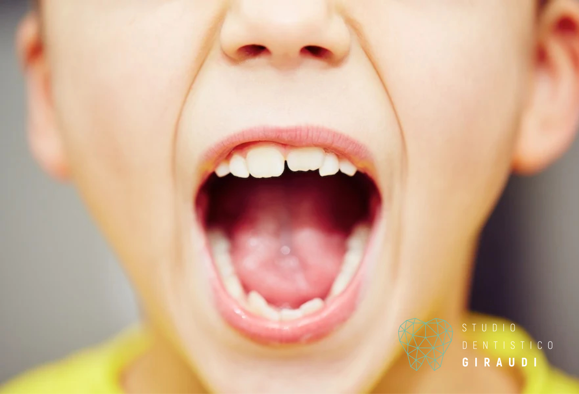 macchie denti bambini