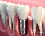 quanto dura un impianto dentale